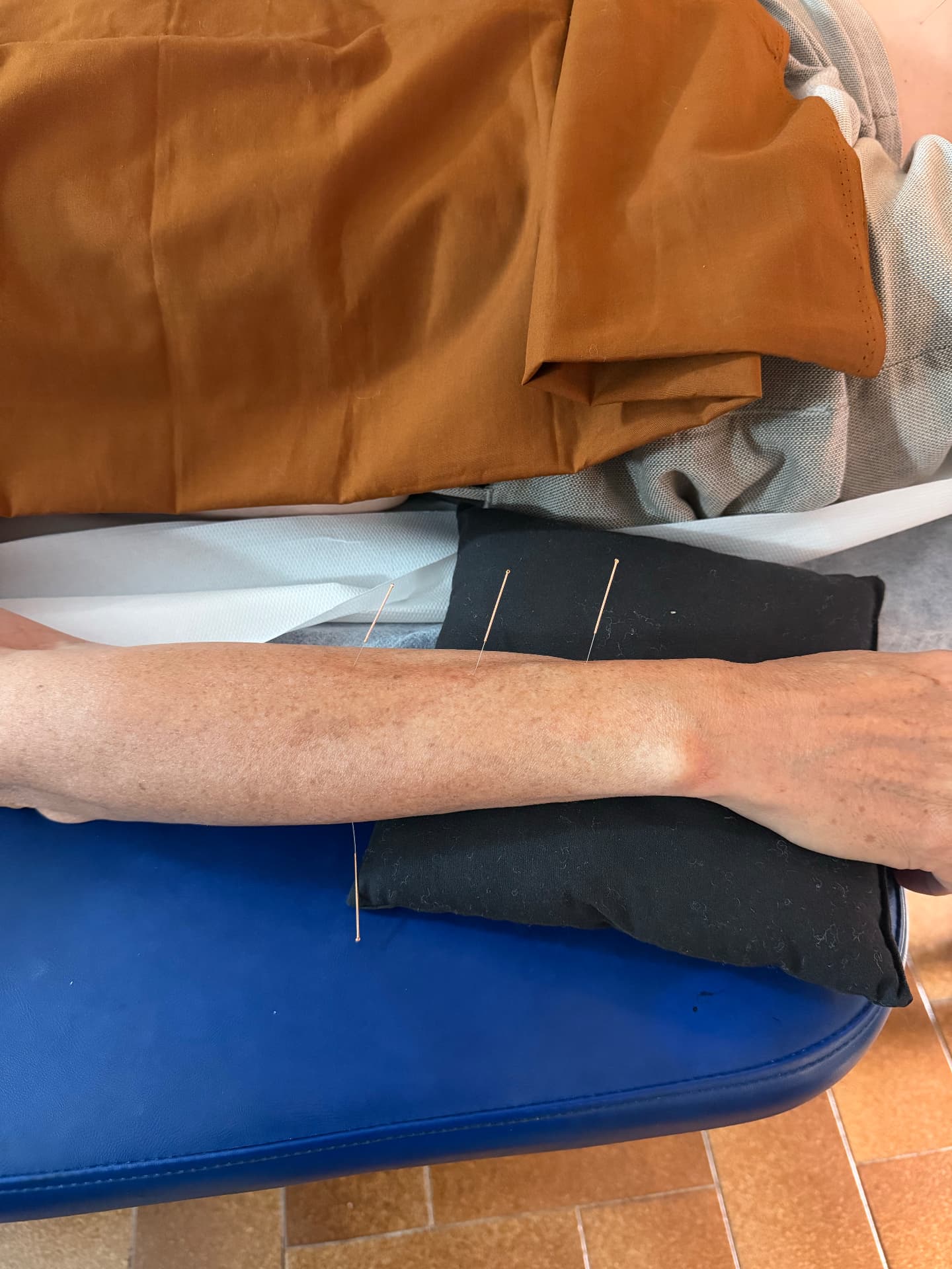 Tratamiento de acupuntura aplicado en el antebrazo