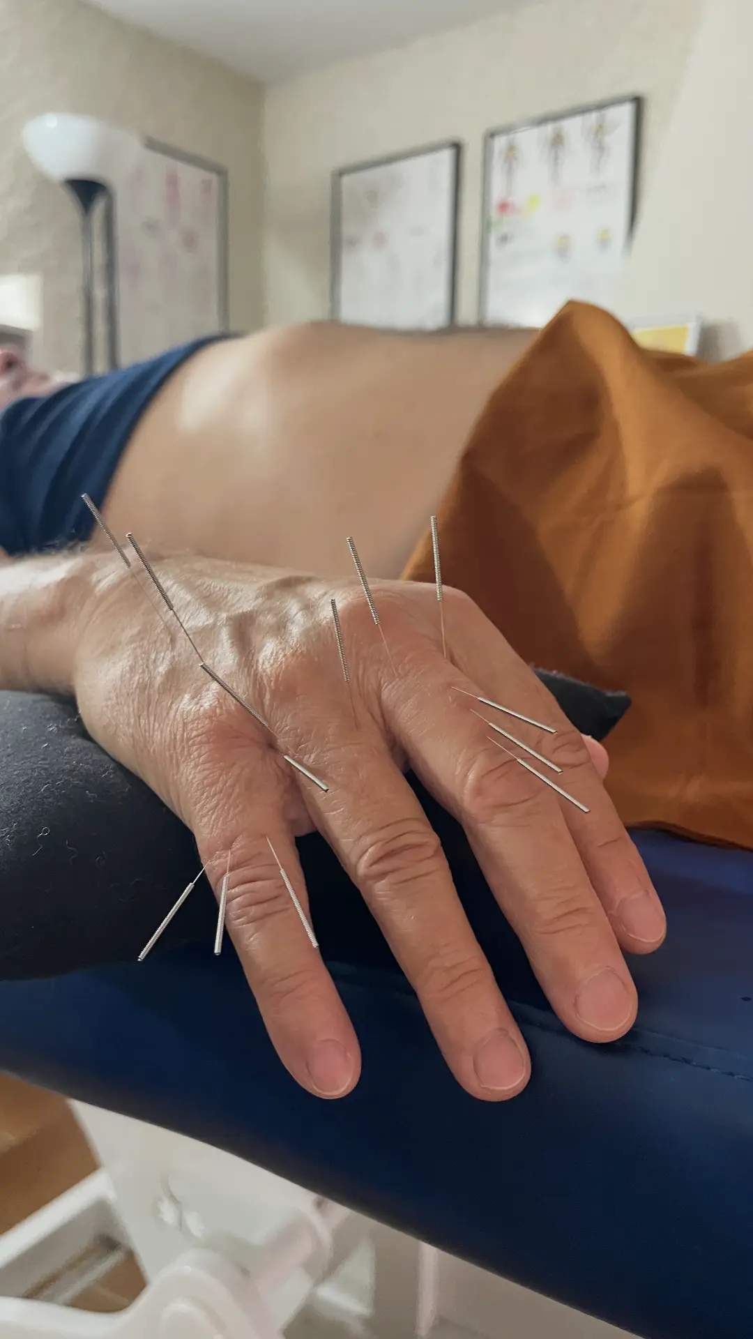 Mano con agujas de acupuntura en tratamiento clínico