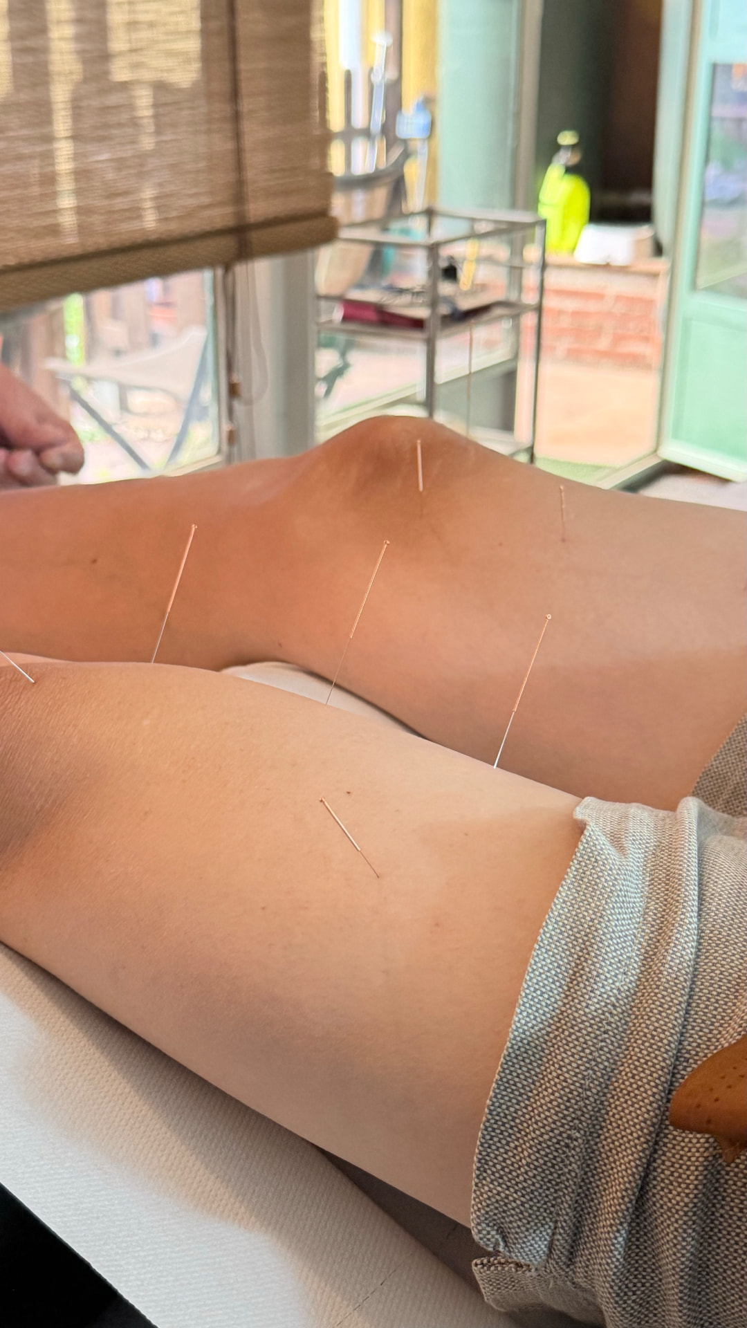 Agujas de acupuntura aplicadas alrededor de las rodillas