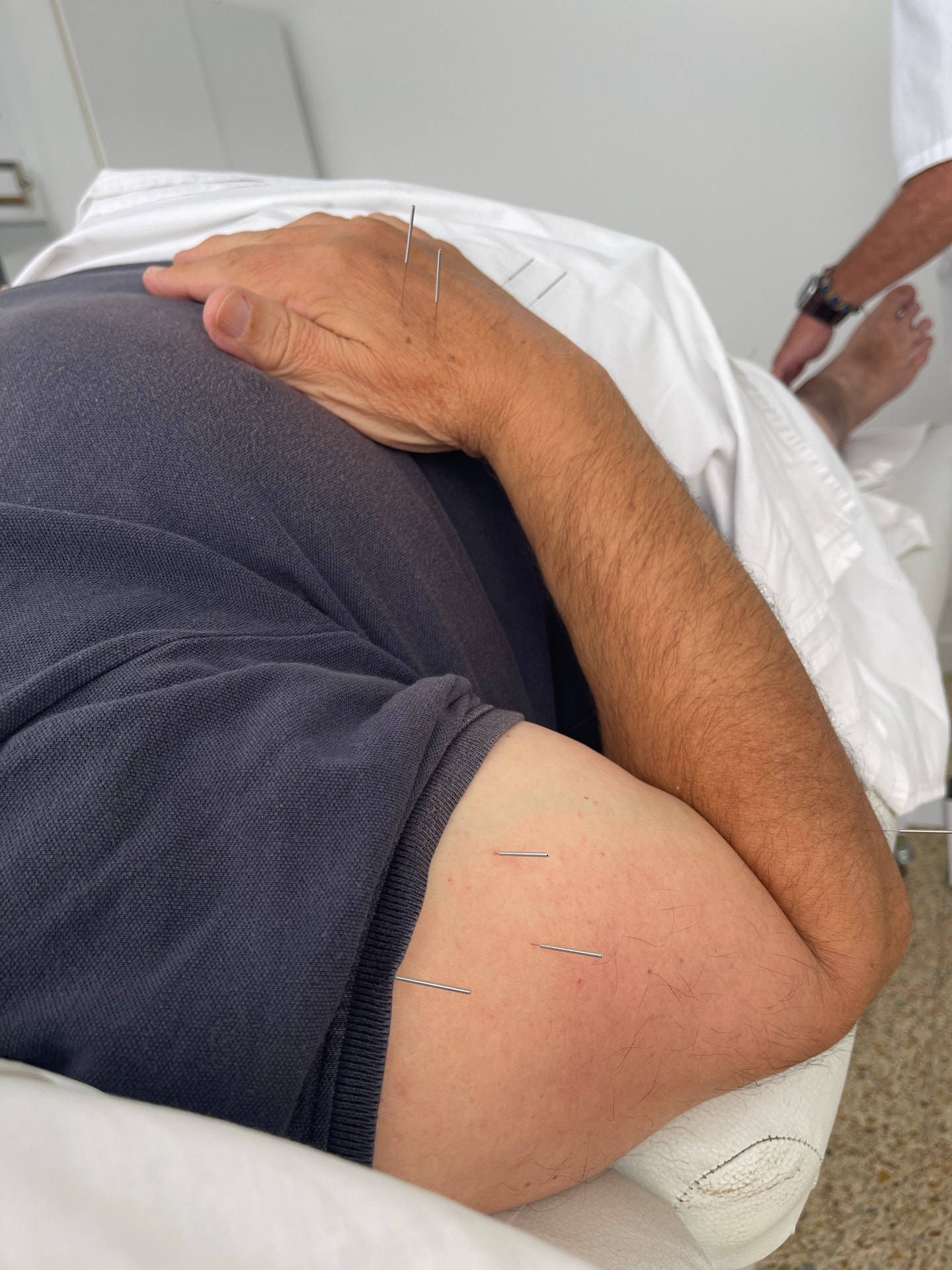 Agujas de acupuntura aplicadas en el brazo y la mano